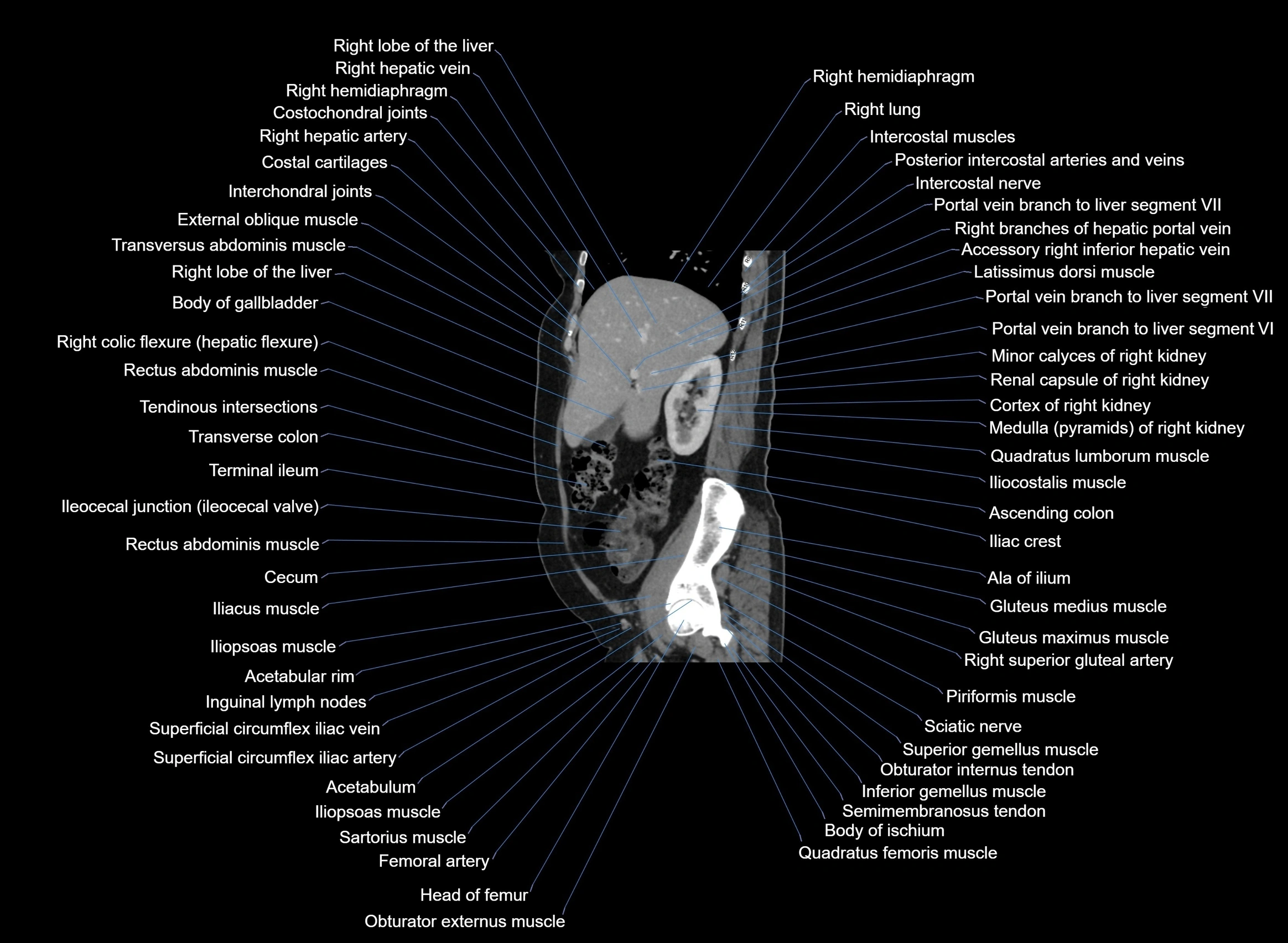 CT Abdomen sagittal cross sectional anatomy labelled radiology image -00082.webp